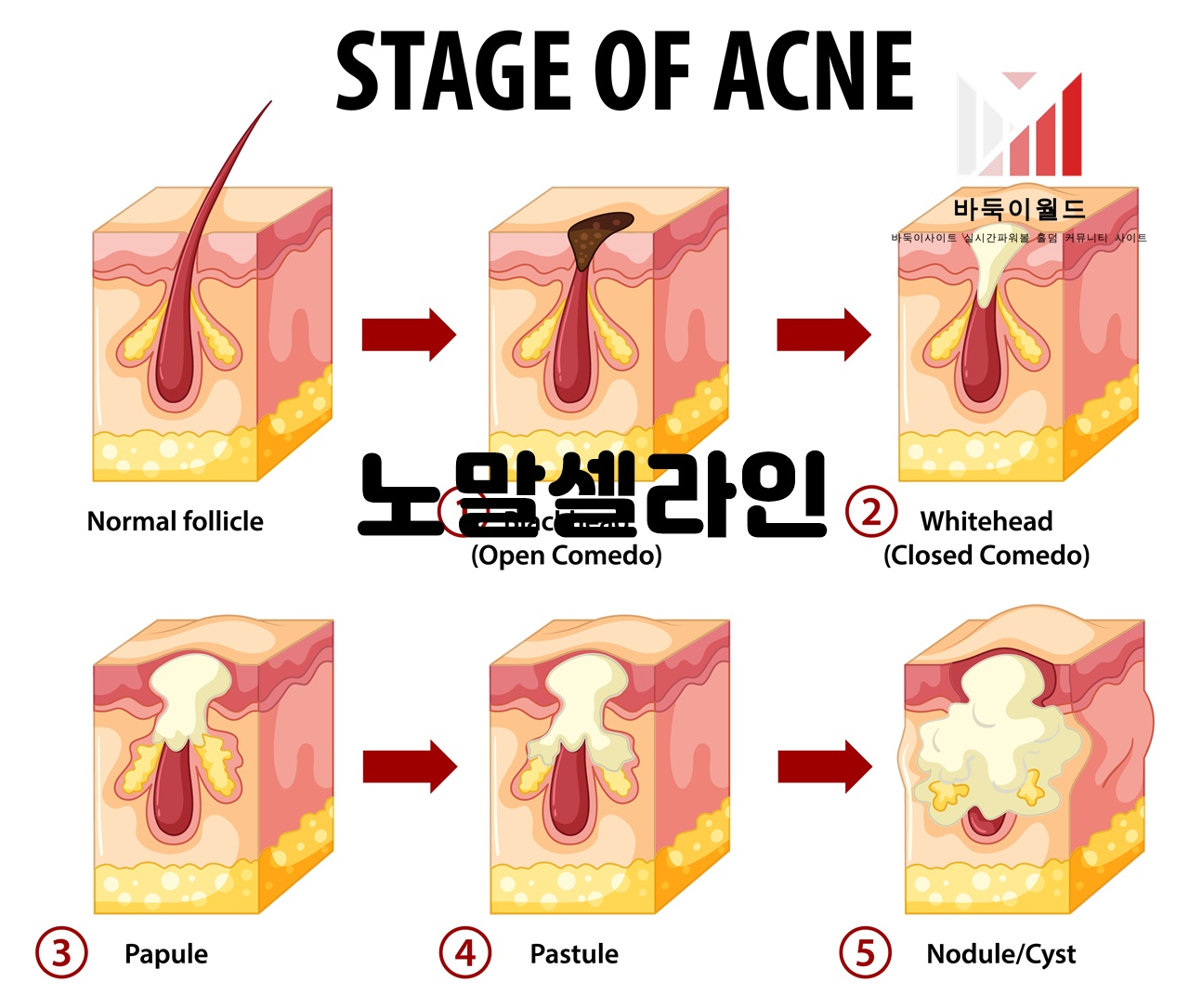 노말셀라인